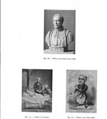 Fig. 178. Nélaton, par Dantan jeune (1863) / Fig. 179. Nélaton et Garibaldi / Fig. 180. Nélaton, par [...]