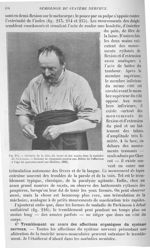 Fig. 215. Attitude de la tête, du tronc et des mains dans la maladie de Parkinson - Sémiologie des a [...]