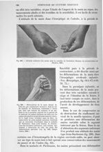 Fig. 299. Attitude ordinaire des mains dans la maladie de Parkinson / Fig. 300. Déformation de la ma [...]