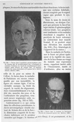 Fig. 321. Facies dans la paralysie pseudo-bulbaire / Fig. 322. Facies dans la maladie de Parkinson - [...]