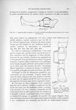 Fig.254.- Appareil plâtré à  anses et à double feuillard métallique pour fracture de la cuisse (Dr.D [...]