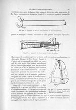 Fig.260.- Appareil de Blacke pour fracture du membre inférieur. Fig.261.- Appareil de Cruet pour fra [...]