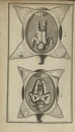 1a - 1b [: enfant avec un cordon ombilical trop court, qui le tien comme en suspens et l'empêche de  [...]