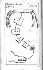 Fracture du nez. Figure 3 - L' appareil commode en faveur des jeunes chirurgiens