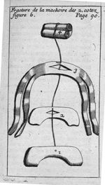 Fracture de la machoire des 2 cotez figure 6 - L' appareil commode en faveur des jeunes chirurgiens