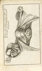 Figure d'un enfant trouvé dans une des trompes de la matrice, où il avoit été formé - Collection des [...]