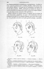 Fig. 446 à Fig. 449 - Traité de médecine opératoire, bandages et appareils. 4è éd. Tome premier