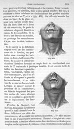 Fig. 452., Fig. 453 - Traité de médecine opératoire, bandages et appareils. 4è éd. Tome premier