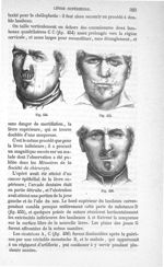 Fig. 454 à Fig. 456 - Traité de médecine opératoire, bandages et appareils. 4è éd. Tome premier