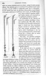 Fig. 655., Fig. 656 - Traité de médecine opératoire, bandages et appareils. 4è éd. Tome premier