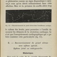 0087 - Page 81 - II. Raccourcissement du grand silence avec rythme spécial. Rythme foetal ou embryocardie. Historique