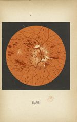 Fig. 49. Rétinite hémorragique au cours de la grossesse - Atlas manuel d'ophtalmoscopie