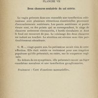 0314 - Page 290 - Planche VII. Deux chancres exulcérés du col utérin