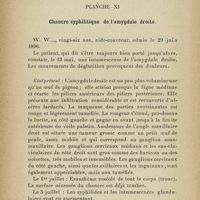 0330 - Page 298 - Planche XI. Chancre syphilitique de l'amygdale droite