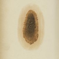 0414 - Tab. 35 - Planche XXXV. Naevus verruqueux