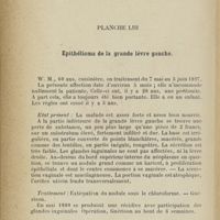 0504 - Page 382 - Planche LIII. Epithélioma de la grande lèvre gauche