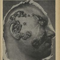 0515 - Page 387 - Planche LV. a. Epithélioma cicatrisant