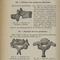 0180 - Page 136 - 2. Fracture des apophyses transverses / 3. Fracture des apophyses épineuses / 4. Fracture de l'arc postérieur