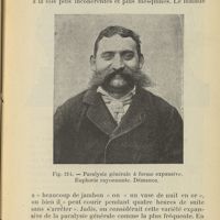 0501 - Page 467 - 2. - Paralysie générale à forme maniaque