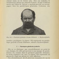 0511 - Page 475 - 7. - Paralysie générale juvénile