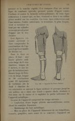 Fig. 126. - Appareil de Pierre Delbet - Traitement des fractures. T. 2 : Fractures diaphysaires