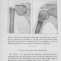 1330 - Page 1278 - Séance du 17 novembre 1920. A propos du procès-verbal. Traitement des fractures de l'humérus par un appareil de contention osseuse, de mobilité articulaire el de motricité musculaire / A propos des perforations duodénales, par M. Lecène