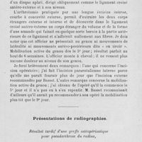 1567 - Page 1511 - Séance du 22 décembre 1920. Présentation de pièce. Corps étranger du ligament croisé antérieur du genou, par M. Albert Mouchet / Présentations de radiographies. Résultat tardif d’une greffe ostéopériostique pour pseudarthrose du radius