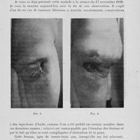 0115 - Page 95 - Deuxième séance. Présentations de malades. Tumeurs fibreuses ulcérées des deux cuisses consécutives à des injections huileuses, par M. Ch. Lenormant