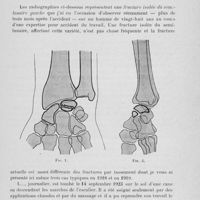 0123 - Page 103 - Deuxième séance. Présentation de radiographies. Fracture du semi-lunaire gauche, par M. Albert Mouchet