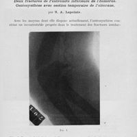 0177 - Page 157 - Séance du 30 janvier. Présentations de malades. Fractures bimalléolaires, par M. P. Alglave / Deux fractures de l’extrémité inférieure de l'humérus. Ostéosynthèse avec section temporaire de l’olécrane, par M. A. Lapointe