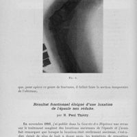 0180 - Page 160 - Séance du 30 janvier. Présentations de malades. Deux fractures de l’extrémité inférieure de l'humérus. Ostéosynthèse avec section temporaire de l’olécrane, par M. A. Lapointe / Résultat fonctionnel éloigné d’une luxation de l'épaule non réduite, par M. Paul Thiéry