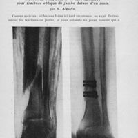 0375 - Page 355 - Séance du 5 mars 1924. Communications. Ulcère peptique d’un diverticule de Meckel provoquant des hémorragies intestinales profuses. Opération. Guérison, par M. L. Guibal / Présentation de malade. Rédaction sanglante avec ostéosynthèse pour fracture oblique de jambe datant d’un mois, par M. Alglave