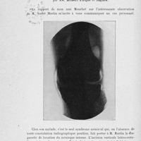 0788 - Page 768 - Séance du 25 juin 1924. A propos du procès-verbal. Rupture du ménisque interne du genou, par MM. Robert Picqué et Jagues