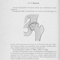 0826 - Page 806 - Séance du 25 juin 1924. Présentations de radiographies. Déformation en champignon de la tête fémorale après un traumatisme grave, par M. Mauclaire