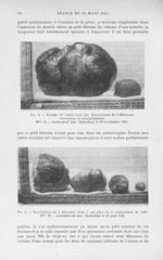 Fig. 2. — Femme de trente-neuf ans. Énucléation de 2 fibromes. Grossesse et accouchement. Mme D…, tr [...]