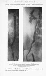 Fig. 4. — Etat de l’uretère dans un phlegmon du ligament large / Fig. 5. — Stigmates d'une grossesse [...]