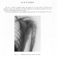 1330 - Page 1297 - Séance du 25 Novembre 1936. Communications. Kyste de l’humérus récidivé. Fracture spontanée. Résection humérale diaphysaire large. Reconstitution humérale par auto-greffe péronière enchevillée, par M. B. Desplas