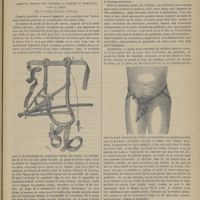 1169 - Page 1157 - Société de chirurgie. Bandages en sac de plâtre ; nouvelle modification du bandage plâtré, par M. Zsigmondi... (Séance du 9 octobre). M. Tillaux... / Instruments et appareils. Gambetto, appareil pour maintenir le cathéter en permanence dans la vessie. Par le Docteur Gaetano Teserone