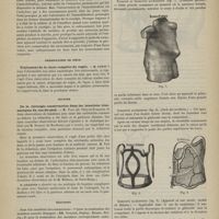 1127 - Page 1125 - Société de chirurgie. Séance du 3 décembre 1879. Suite de la discussion sur la mobilisation des articulations malades. M. Le Fort / Présentation de pièce. Traitement de la chute complète du vagin. M. Panas / Lecture. De la chirurgie conservatrice dans les luxations traumatiques du cou-de-pied. M. Vast... / Élections / Instruments et appareils. Appareils orthopédiques de MM. Rainal frères