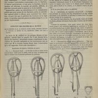 0479 - Page 467 - Hôpital Necker. M. Trélat. Fractures de l'extrémité inférieure du péroné / Opération des polypes de la matrice par le procédé de M. le Docteur Lucien Boyer, sercision (section du pédicule au moyen du fil, manoeuvré comme une scie à chaine)