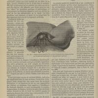 0176 - Page 164 - Hôpital Necker. M. Rendu. Sclérose hépatique diffuse par lithiase biliaire. (Leçon recueillie par M. le Docteur Leflaive...) / Hôpital Saint-Louis. M. Péan. Du morcellement appliqué à l'ablation des tumeurs. (Leçons recueillies par M. Lapervenche...)