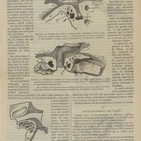 0223 - Page 211 - Revue générale. De l'apophyse mastoïde et de sa trépanation. Par M. le Docteur A. Ricard... (Mémoire couronné par l'Académie, Prix Meynot 1888). III. Cellules mastoïdiennes / IV. Cellules mastoïdiennes chez l'enfant
