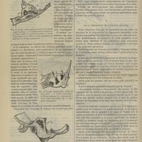 0224 - Page 212 - Revue générale. De l'apophyse mastoïde et de sa trépanation. Par M. le Docteur A. Ricard... (Mémoire couronné par l'Académie, Prix Meynot 1888). IV. Cellules mastoïdiennes chez l'enfant / V. De la trépanation de l'apophyse mastoïde