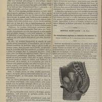 0406 - Page 394 - Hôpital Necker. M. Peter. Des méfaits du rhumatisme / Hôpital Saint-Louis. M. Péan. Du morcellement appliqué à l'ablation des tumeurs. (Leçons recueillies par M. Lapervenche...)