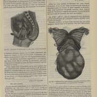 0407 - Page 395 - Hôpital Saint-Louis. M. Péan. Du morcellement appliqué à l'ablation des tumeurs. (Leçons recueillies par M. Lapervenche...). [Correspondance]. [Dr. L. Landau]