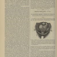 0520 - Page 508 - Hôpital de la Pitié. M. Lancereaux. Quelques formes de tuberculose pulmonaire. (Leçon recueillie par M. le Docteur Paul-Raymond...) / Hôpital Saint-Louis. M. Péan. Du morcellement appliqué à l'ablation des tumeurs. (Leçons recueillies par M. Lapervenche...)