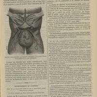 0521 - Page 509 - Hôpital Saint-Louis. M. Péan. Du morcellement appliqué à l'ablation des tumeurs. (Leçons recueillies par M. Lapervenche...) / Rétrécissement de l'urèthre. Échec de la dilatation lente et de la dilatation rapide, électrolyse linéaire ; par M. le Docteur J.-A. Fort...