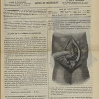 0645 - Page 633 - Sommaire / Séance de l'Académie de médecine / Hôpital Saint-Louis. M. Péan. Du morcellement appliqué à l'ablation des tumeurs. (Leçons recueillies par M. Lapervenche...)