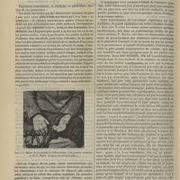 1174 - Page 1162 - Revue générale. L'acromégalie. Par M. le Docteur Georges Guinon... I / II