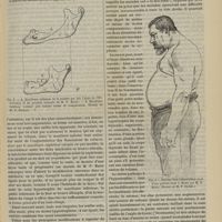 1175 - Page 1163 - Revue générale. L'acromégalie. Par M. le Docteur Georges Guinon... II / III